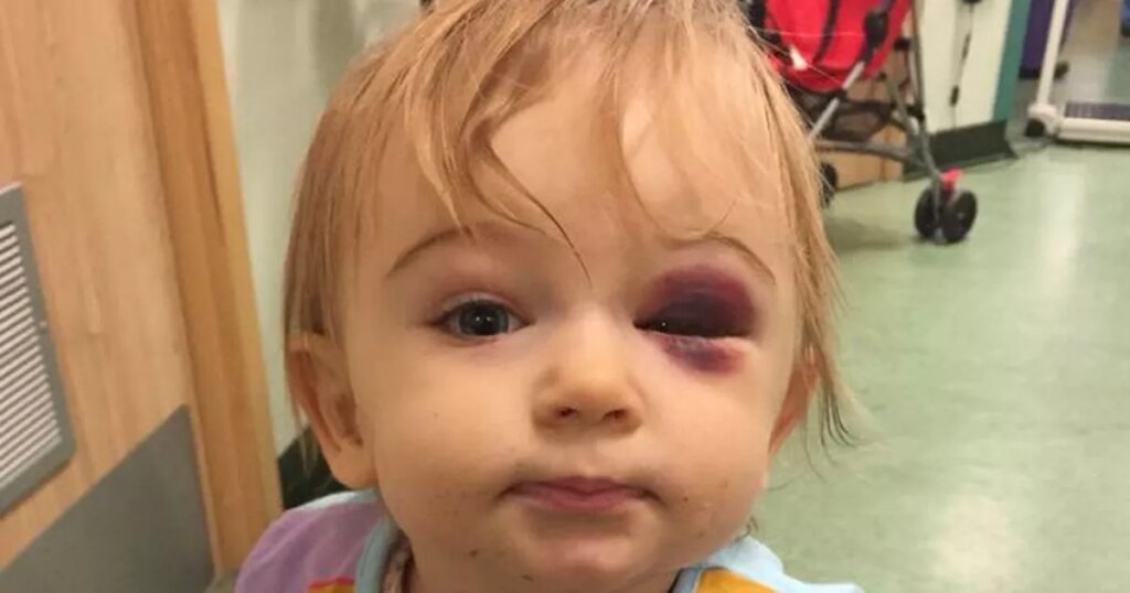 News: Baby fractures skull after falling through spindles on upstairs landing